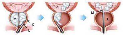 Adenome