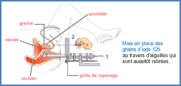 Curietherapie