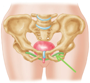 Incontinence urinaire chez la femme
